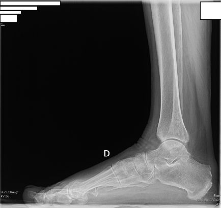 Proyección Lateral Pie con Carga Anatómica